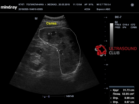 Изменения селезенки. Спленомегалия селезенки УЗИ. Спленомегалия УЗИ селезенки кошки. Образования селезенки на УЗИ.