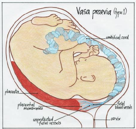 best-of-velamentous-cord-insertion-pictu