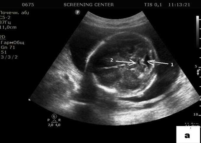 Гипоплазия червя. Денди-Уокера аномалия УЗИ. Агенезия червя мозжечка УЗИ. Гипоплазия мозжечка, аномалия Денди-Уокера. Гипоплазия червя мозжечка у плода на УЗИ.